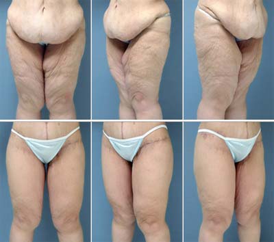 Thigh Lift Surgery: Comparing the Surgical Techniques