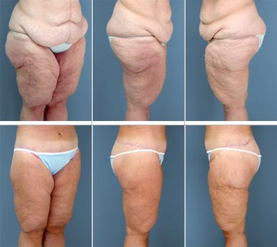 Thigh Lift « Brookside Plastic, Cosmetic & Reconstructive Surgery